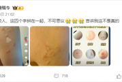 “蟑螂咬人”上热搜 《博物杂志》分析辟谣：三种可能