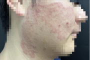 宁波小伙拿擦脚巾擦脸 结果脚气上脸！专家：有人闻臭袜肺部感染